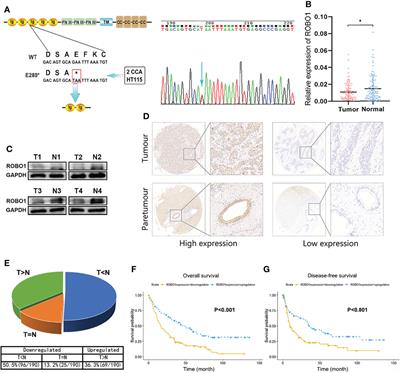 ROBO1 p.E280* Loses the Inhibitory Effects on the Proliferation and Angiogenesis of Wild-Type ROBO1 in Cholangiocarcinoma by Interrupting SLIT2 Signal